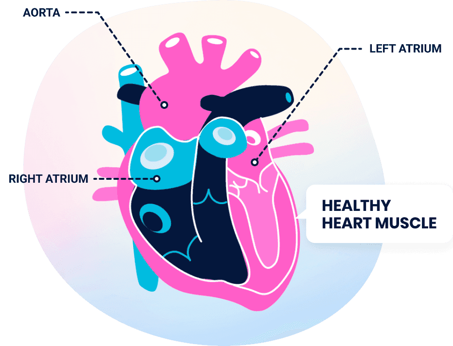 Heart illustration showing normal heart